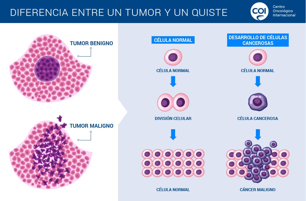 ¿Cuál es la diferencia entre un tumor y un quiste?