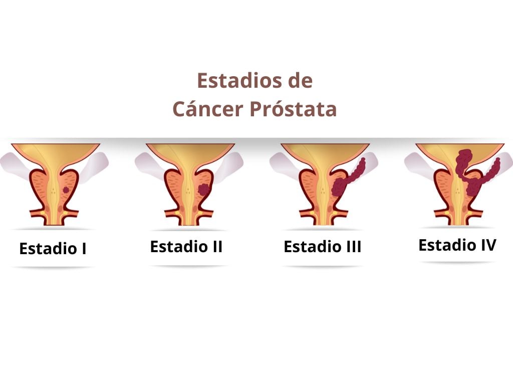 estadios-cancer-prostata