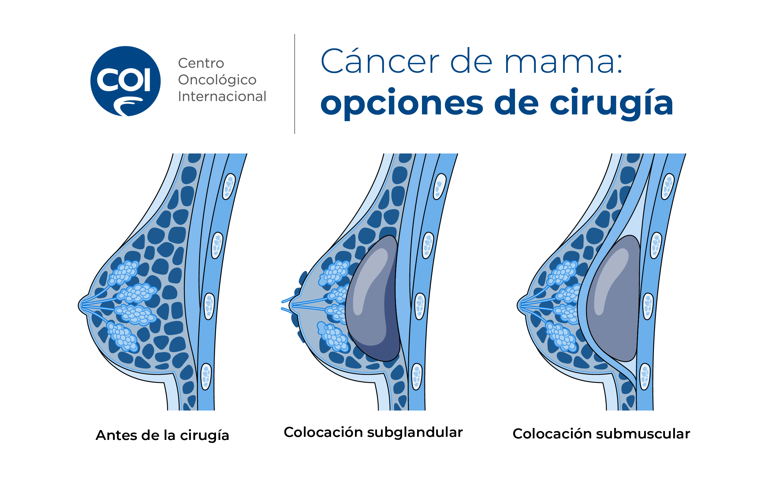 reconstruccion-con-implantes