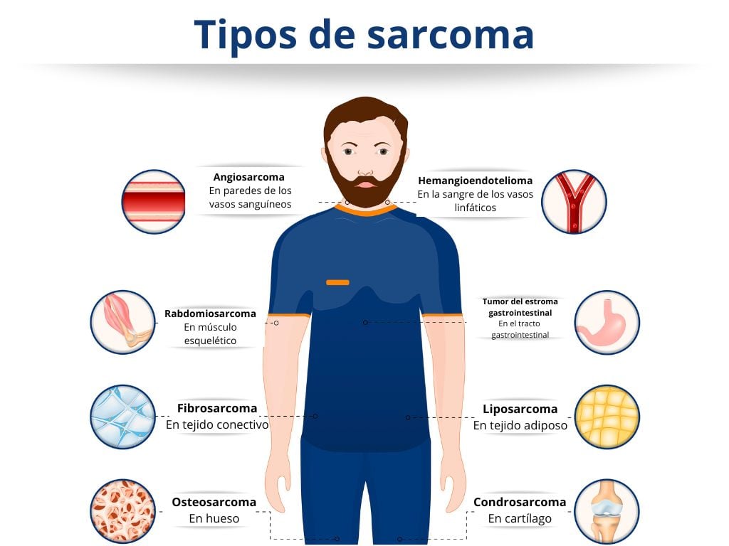 tipos-de-sarcoma